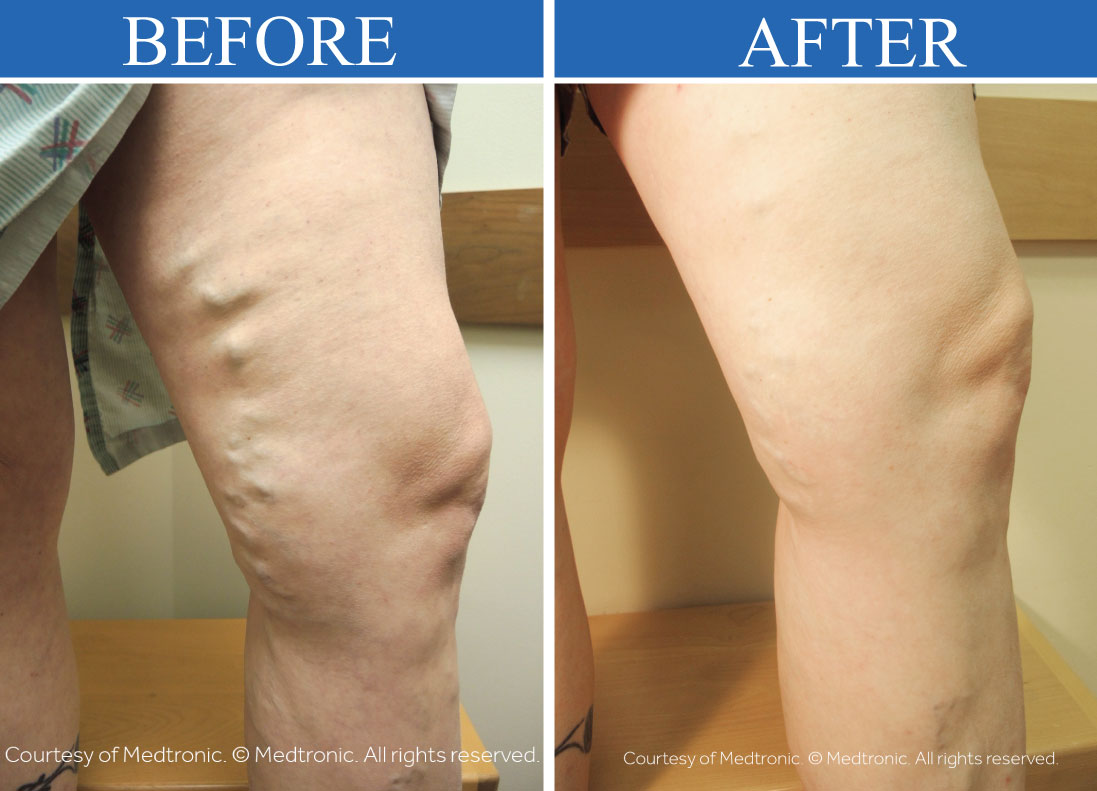 before and after varicose vein treatment longmont colorado