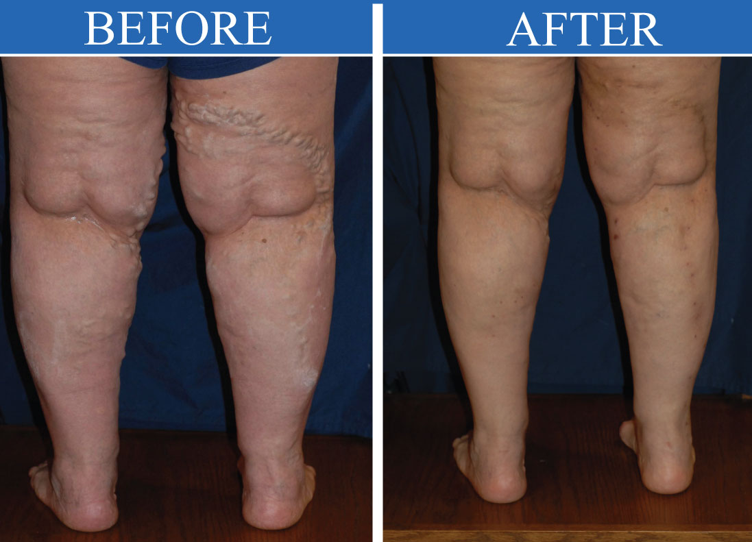 before and after varicose vein treatment longmont colorado